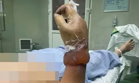 Người phụ nữ có nguy cơ bị cụt cẳng tay khi dựng cây nêu đón Tết