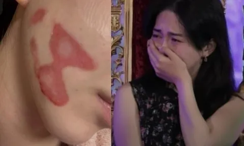 Nữ thần sắc đẹp showbiz bị bỏng mặt nghiêm trọng hậu thẩm mỹ, nhìn tình hình hiện tại mà xót thay