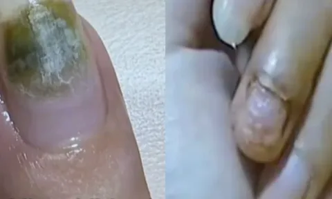 Trung Quốc: Tiệm nail khiến nhiều người nhiễm HPV do khử trùng dụng cụ làm móng qua loa