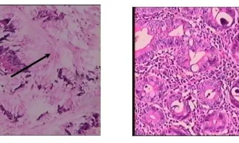 Bệnh viện 115 cảnh báo loại giun ký sinh trong ruột: Không triệu chứng, nhưng gây tử vong nếu uống sai thuốc kháng sinh