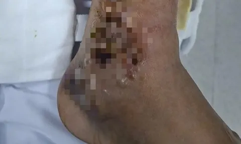 Đắp thuốc, một người đàn ông suýt mất chân