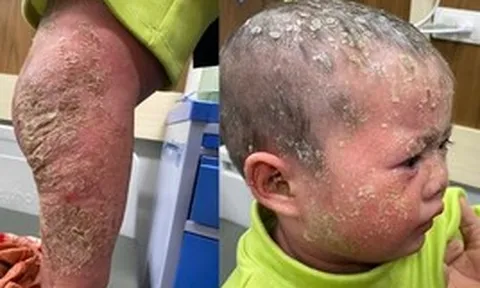 'Con đau lắm, bố ơi'-tiếng khóc xé lòng của bé gái 3 tuổi có làn da như 'lửa thiêu'