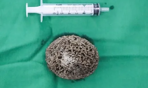 Người đàn ông 50 tuổi đau hạ vị kéo dài, bác sĩ sốc khi gắp ra thứ "đáng sợ" bằng quả trứng ngỗng