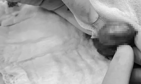 Nửa đêm đau âm ỉ vùng kín, nam sinh suýt mất tinh hoàn vì chủ quan