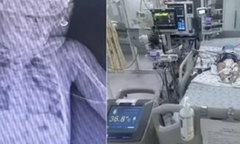 Bé gái mới biết đi bị ngã vào thùng nước khiến ngưng tim ngưng thở