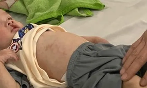 Số ca sốt xuất huyết và tay chân miệng tăng nhiều lần