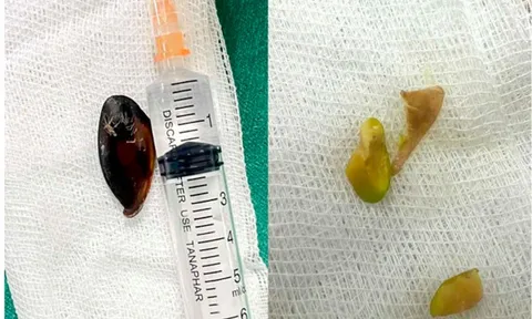 Bé 14 tuổi ho khan kéo dài, gia đình sốc khi bác sĩ lấy ra dị vật bên trong cơ thể