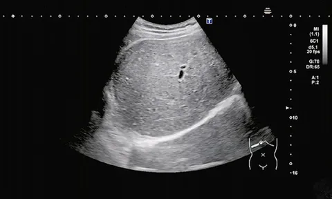 Nam sinh 15 tuổi "gan trắng xoá", bác sĩ chỉ thẳng do 2 món khoái khẩu "vạn người mê”