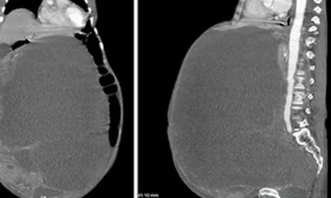 Người phụ nữ nhập viện vì bụng to bất thường, kết quả kiểm tra khiến cả gia đình sửng sốt