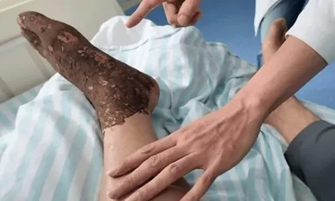Bị rắn độc cắn khi đang cấy lúa, người đàn ông làm 1 việc khiến bác sĩ khen ngợi
