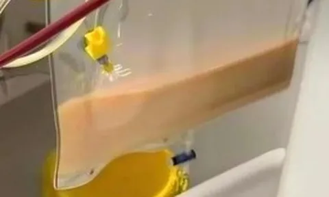 Người đàn ông 40 tuổi có "máu trắng đục như sữa", bác sĩ cảnh báo thói quen "sướng miệng, hại thân"
