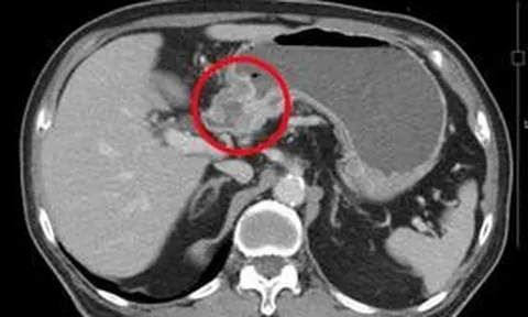 Có dấu hiệu này suốt nửa năm nhưng không đi khám, người đàn ông 68 tuổi mắc ung thư giai đoạn 3