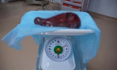Bụng người đàn ông 69 tuổi ngày càng phình to, bác sĩ sững sờ khi phát hiện thứ "khổng lồ" bên trong