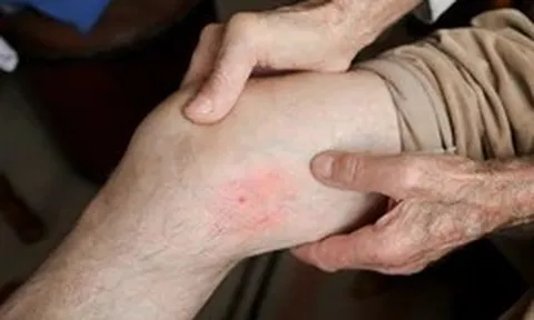 Những triệu chứng tiềm ẩn của cục máu đông không nên bỏ qua