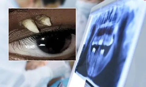 Thiếu nữ 16 tuổi có răng mọc hốc mắt