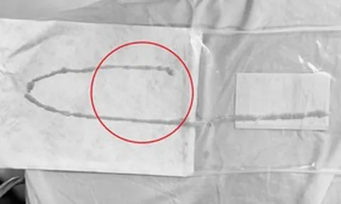 Người phụ nữ 48 tuổi sốc khi bác sĩ gắp ra thứ "đáng sợ" bên trong bụng