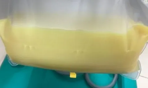 Người phụ nữ 32 tuổi máu "trắng đục như sữa", bác sĩ "chỉ mặt điểm tên" thói quen ít ai ngờ